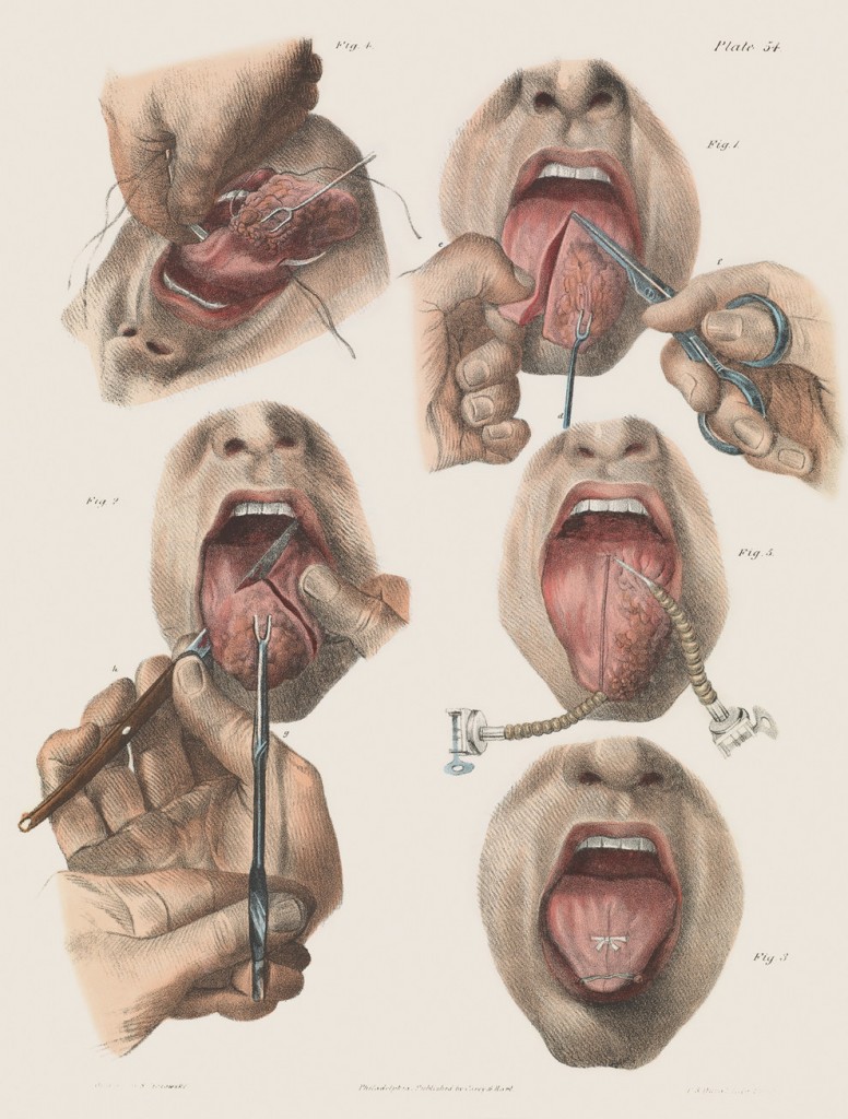 舌癌手术.