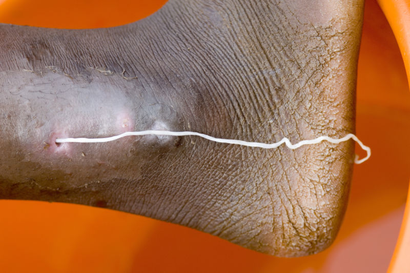 A patient with a guinea worm emerging, at the Savelugu Case Containment Center. (Photo by Louise Gubb/Corbis via Getty Images)